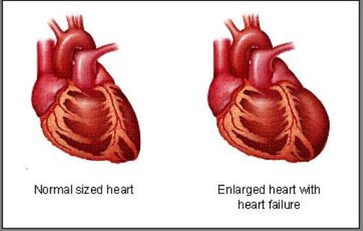 heart-failure2