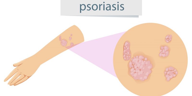 What Is Psoriasis and How Can You Manage It?