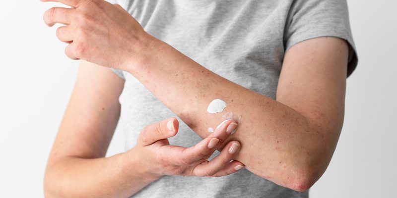 Optimizing Skin Hydration: Effective Strategies for Managing Atopic Dermatitis