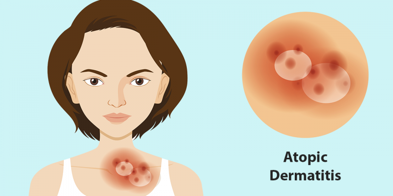 Understanding and Managing Atopic Dermatitis Triggers